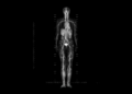 Whole-Body MRI Cancer Screening
