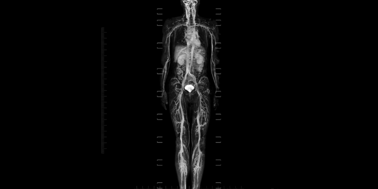 Whole-Body MRI Cancer Screening